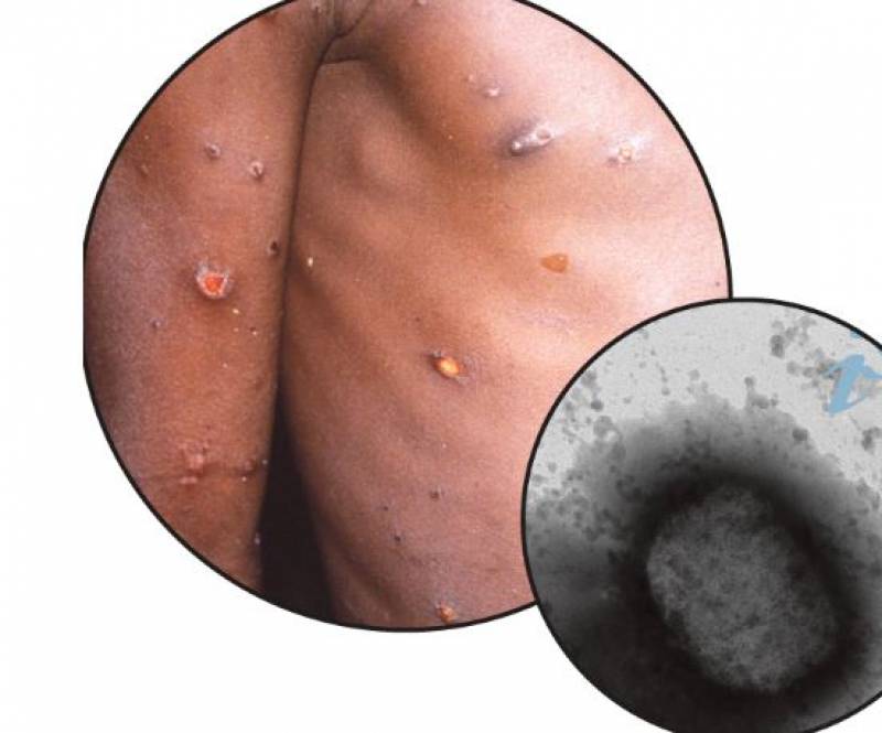 Mpox infection reported in Murcia as WHO declares international health emergency